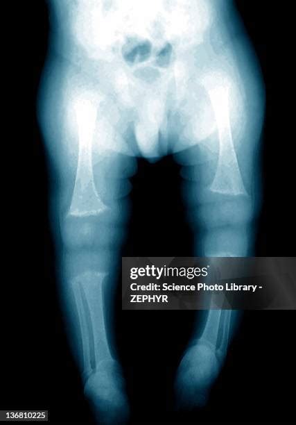 25 Rickets Disease Stock Photos, High-Res Pictures, and Images - Getty ...