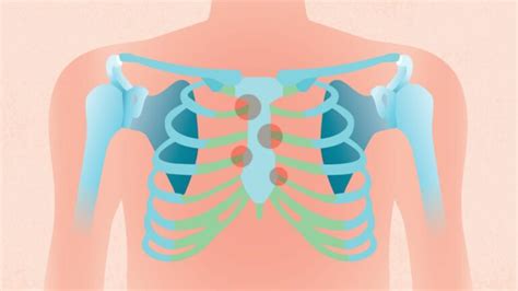 Physical Therapy for Costochondritis: Techniques & Benefits