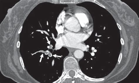 Pulmonary CT angiography image in 43-year-old woman shows acute... | Download Scientific Diagram