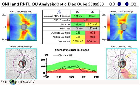 Atlas Entry - Optic Disc Notch and Retinal Nerve Fiber Layer Defect in ...