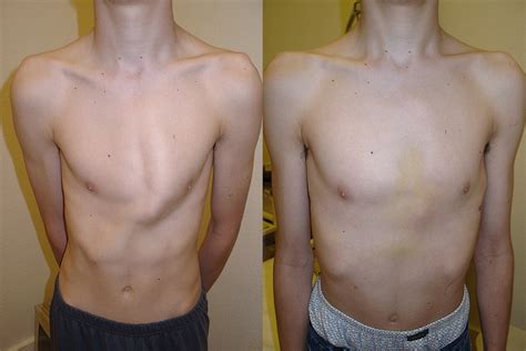 Initial results with minimally invasive repair of pectus carinatum - The Journal of Thoracic and ...