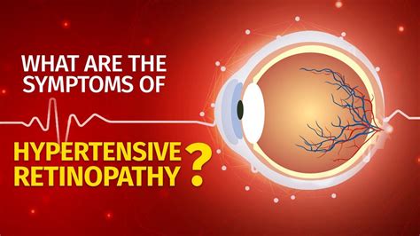 What are the symptoms of Hypertensive Retinopathy | Causes | Prevention ...