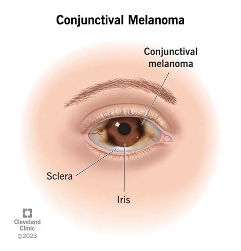 Conjunctival Melanoma