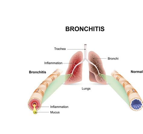 How To Cure Acute Bronchitis - Internaljapan9