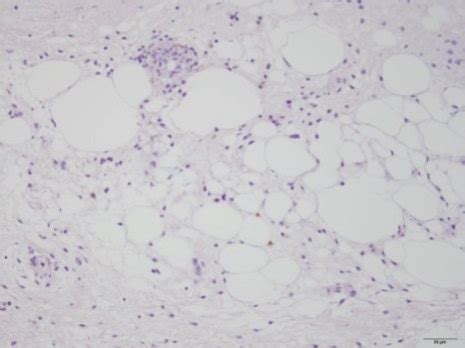 Histology of the primary site-dedifferentiated liposarcoma (a, b) and ...