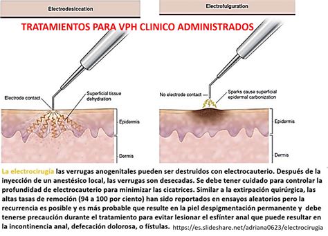 #VPH, #Tratamiento, #Condilomas, #Verrugas, #ETS, #ITS. Tratamiento ...