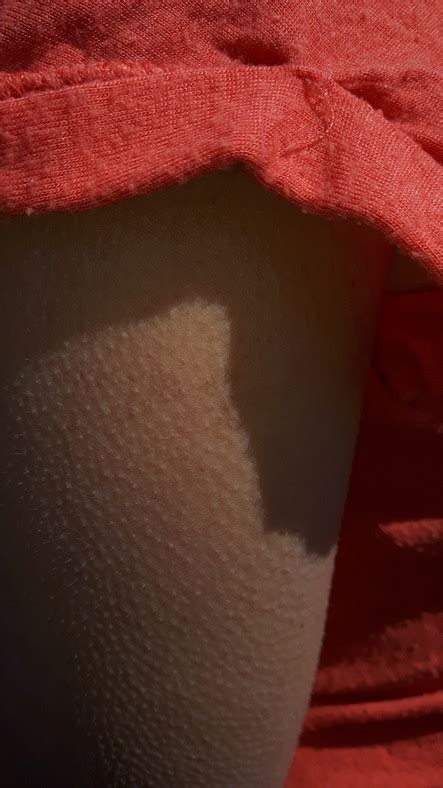 Wondering about goosebumps? Of course you are - Harvard Health