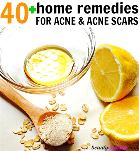 40 + DIY Acne Remedies That Work! (Including Pimples, Acne Scars & Blemishes) - beautymunsta ...