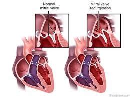 Mitral Kapak Yetersizliği - Doç.Dr.Muhammed Keskin I Kardiyoloji Uzmanı