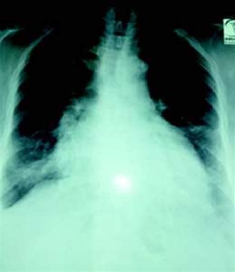 Chest X-ray represents Cardiomegaly. | Download Scientific Diagram