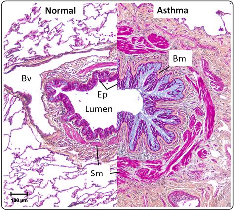 Histology: Respiratory (Lung Section - normal and asthma comparison) | Asthma treatment, Asthma ...