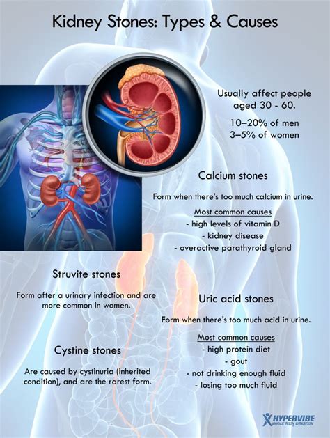 Types and causes of kidney stones #health #infographic #kidney #stones | Healthy Infographics ...