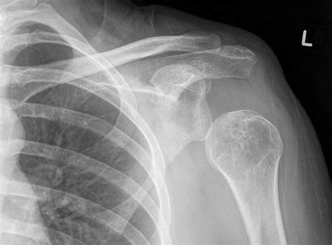 Shoulder Subluxation - Physiopedia