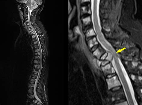 Cord compression - multiple myeloma - Radiology at St. Vincent's ...