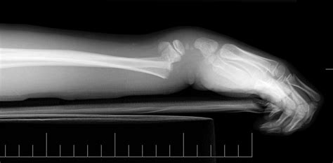 Fractures -- Colles vs. Smith | Student Doctor Network