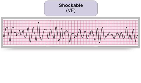 What Are Non Shockable Rhythms