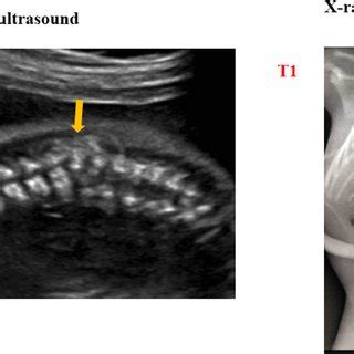 (PDF) Twin pregnancy complicated with congenital Hemivertebra: report ...