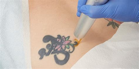 Picoway Laser Tattoo Removal Toronto | Lunae Cosmetic Clinic