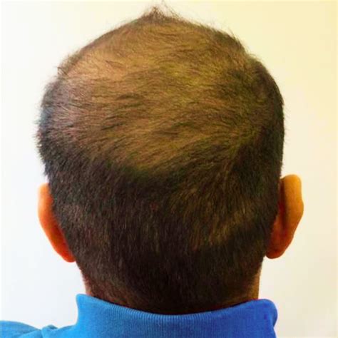 Laser for Hair Growth - Shumaila's London Aesthetics and Laser Clinic