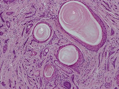 Cureus | Desmoplastic Trichoepithelioma: Histopathologic and ...