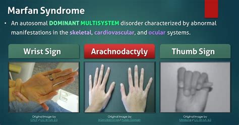 Marfan syndrome,What to know?