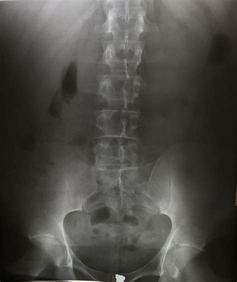 Approach to Thoracic and Lumbar Spine X-ray | Epomedicine