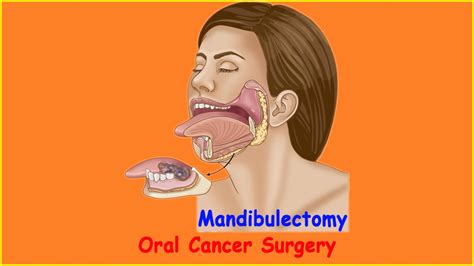 Oral Cancer Surgery Commando with Marginal Mandibulectomy and Neck Dissection - YouTube