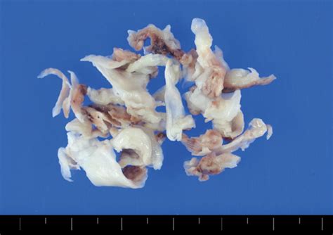 Diphtheria Pseudomembrane Removal