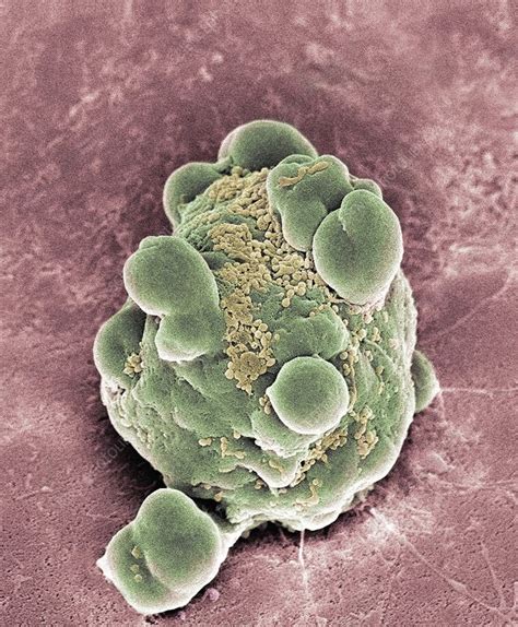 Cancer cell apoptosis, SEM - Stock Image - M132/0905 - Science Photo Library