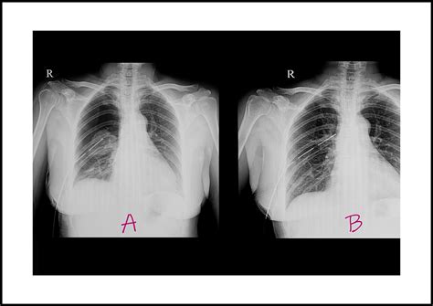 Understanding Pleural Effusion: Causes and Nursing interventions