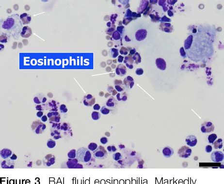 Acute Eosinophilic Pneumonia. Causes, Diagnosis, and Management ...