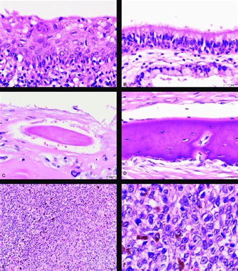 Histology of malignant melanoma arising in ovarian cystic teratoma ...