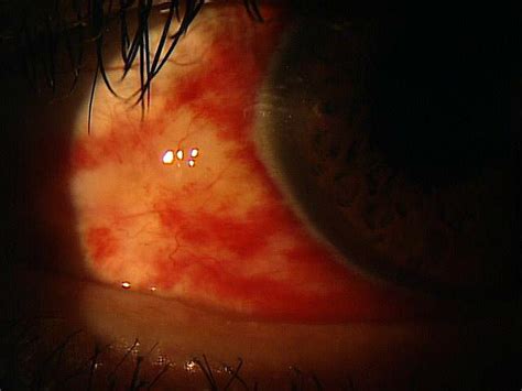 H11.31-33 Subconjunctival Hemorrhage - Decision-Maker PLUS