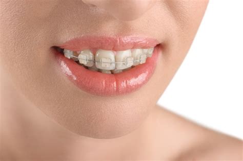 The Pros and Cons of Ceramic Braces - Belmont Smiles - Orthodontist Belmont, MA