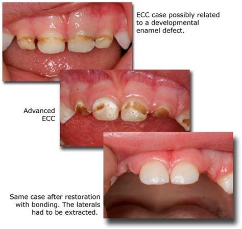 Early Childhood Caries - Holistic Dentistry Sarkissian DDS