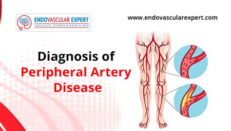 Diagnosis Of Peripheral Artery Disease. | EndovascularExpert