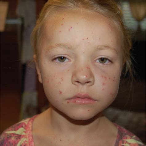 Papular Rash in a Child After a Fever | AAFP