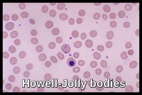 Miscellaneous Red Cell Abnormalities - Ask Hematologist | Understand Hematology