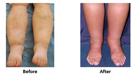 Leg Swelling Specialists in Maryland, New Jersey, and Virginia | Leg Pain Doctors