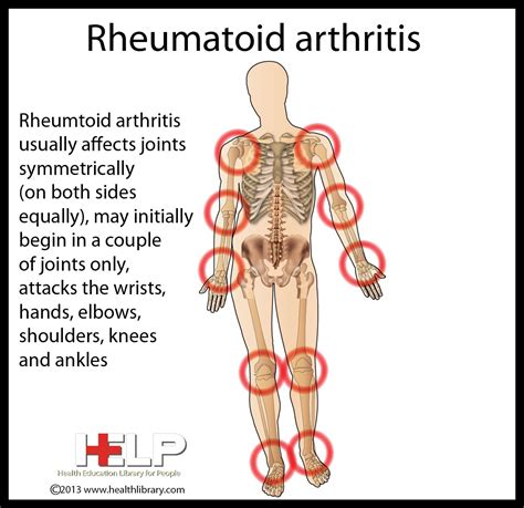 Rheumatoid arthritis symptoms causes and natural support strategies ...