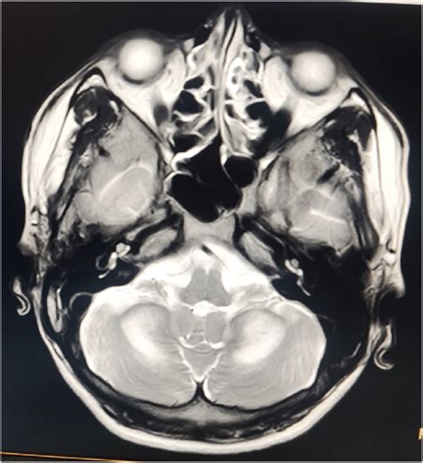 MRI scan of cerebellum showing hyper intensity along the medial aspect... | Download Scientific ...