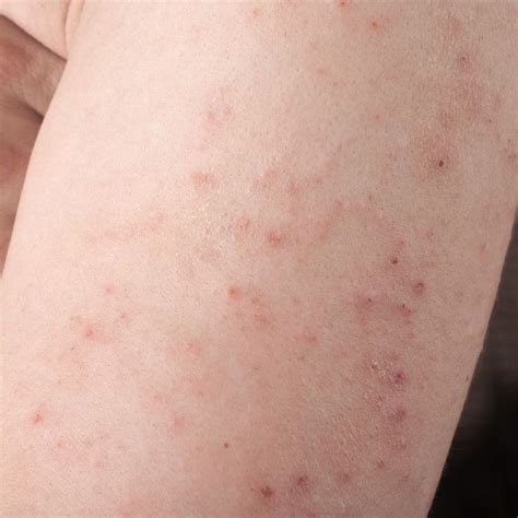 Diabetic Skin Rash Pictures – Effective Health