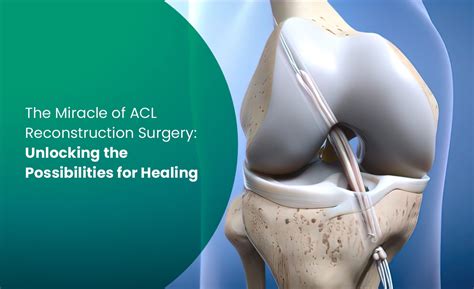 The Miracle of ACL Reconstruction Surgery