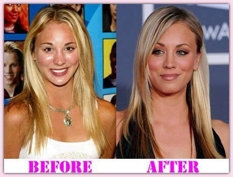 Kaley Cuoco Plastic Surgery - Looking Amazing Now | Plastische chirurgie