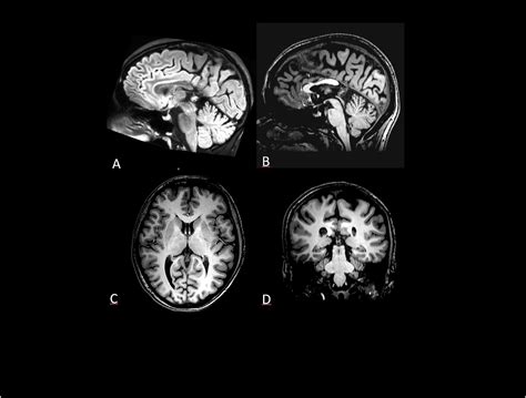 Frontiers | Selective Emotional Dysregulation in Splenium Agenesis. A Case Report of a Patient ...