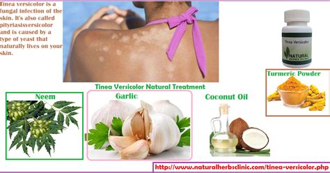 Tinea Versicolor Natural Treatment