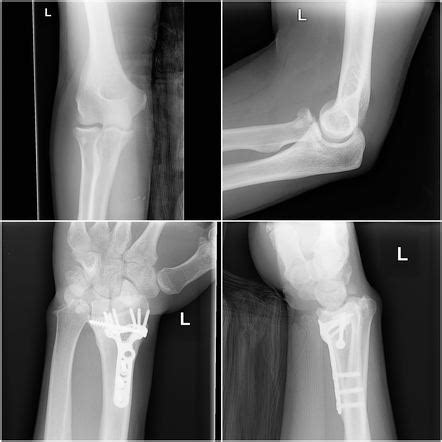 Essex Lopresti Fracture Dislocation Radiology Reference Article | Hot Sex Picture