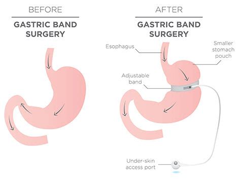 LAP BAND® Surgery - Johns Creek, Alpharetta, Roswell, Atlanta | Johns ...