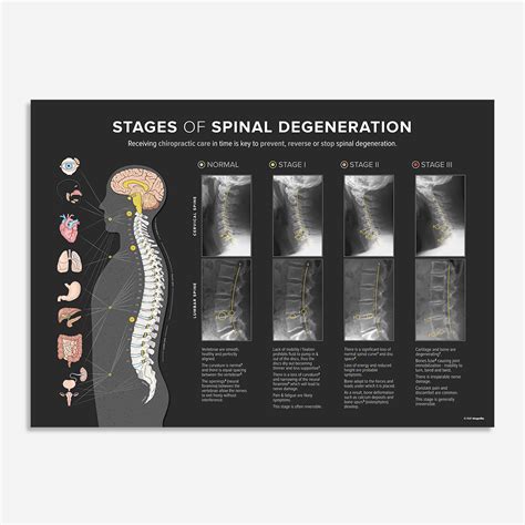 STAGES of SPINAL DEGENERATION - Cx / Lx - Chiropractic poster