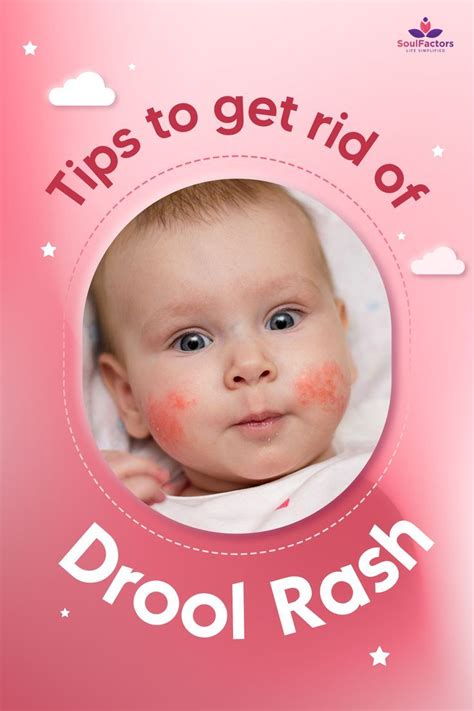 Tips To Get Rid of Drool Rash | Baby rash remedies, Baby rash, Drooling ...